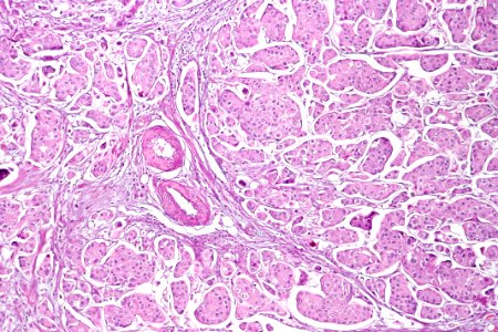 Urothelial carcinoma with micropapillary features, intermed. mag