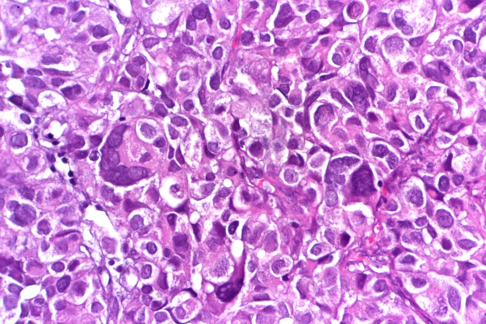 Urothelial carcinoma with marked pleomorphism, very high mag.2