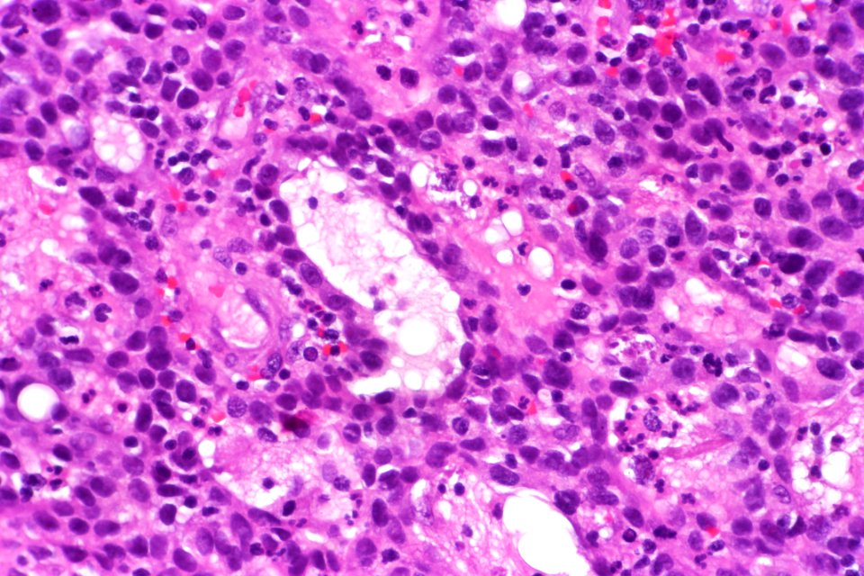 Urothelial carcinoma with glandular differentiation, very high mag