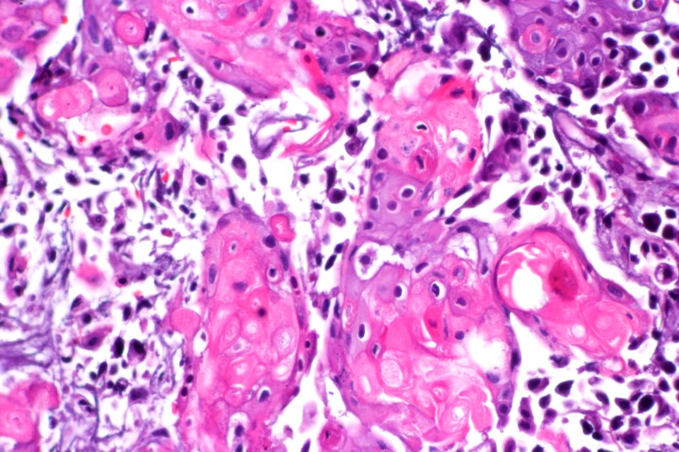 Urothelial carcinoma with squamous differentiation, very high mag