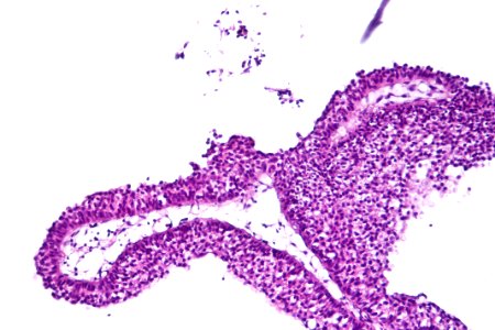 Urothelial papilloma, high mag.1