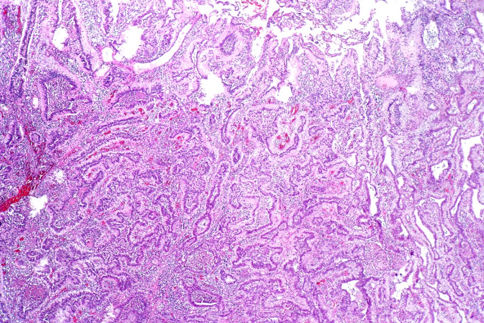 Urothelial carcinoma with villoglandular differentiation, low mag.1