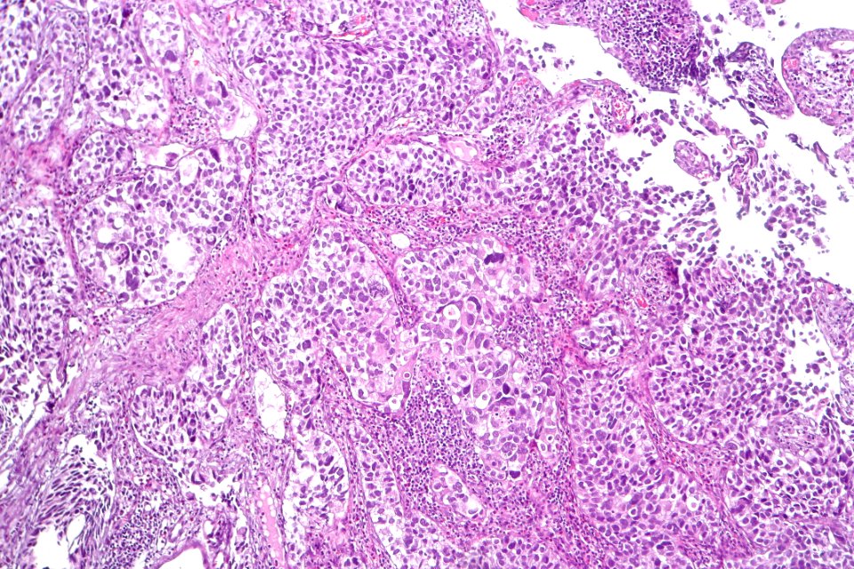Urothelial carcinoma with marked pleomorphism, intermed. mag.1