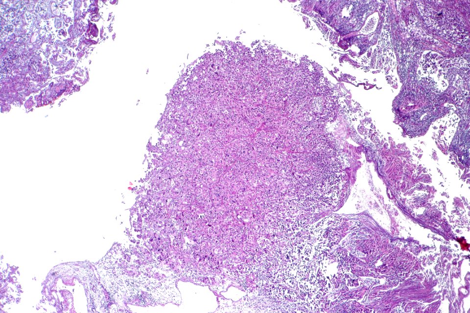 Urothelial carcinoma with marked pleomorphism, low mag