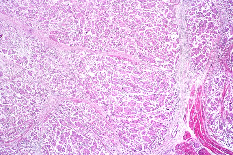 Urothelial carcinoma with micropapillary features, low mag.2