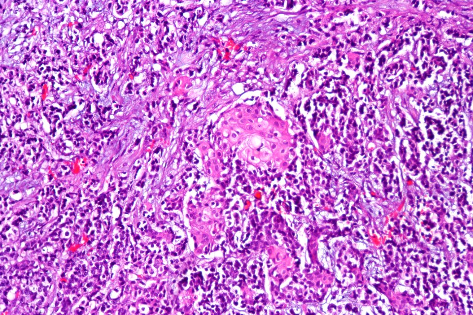 Urothelial carcinoma with squamous differentiation, high mag.1