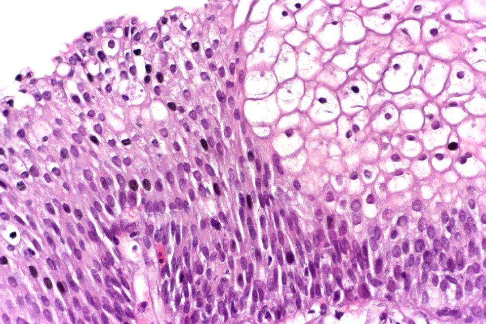Urothelial hyperplasia, very high mag