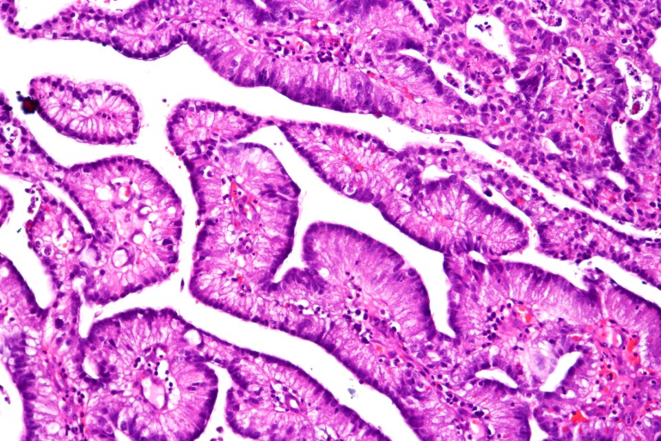Urothelial carcinoma with villoglandular differentiation, high mag