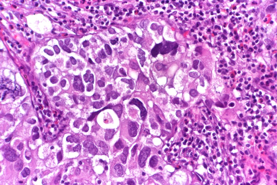 Urothelial carcinoma with marked pleomorphism, very high mag.1