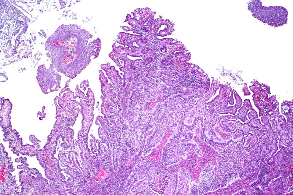 Urothelial carcinoma with villoglandular differentiation, low mag.2