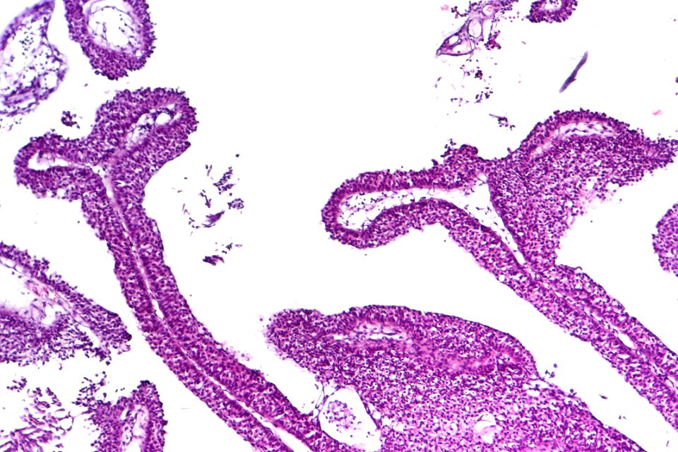 Urothelial papilloma, intermed. mag.1