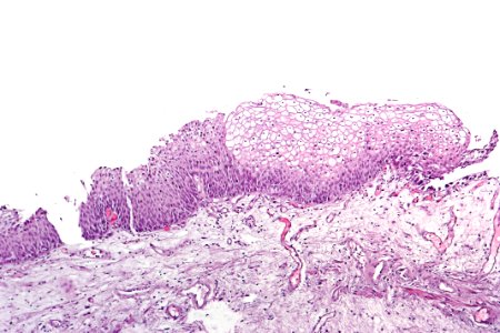 Urothelial hyperplasia, intermed. mag