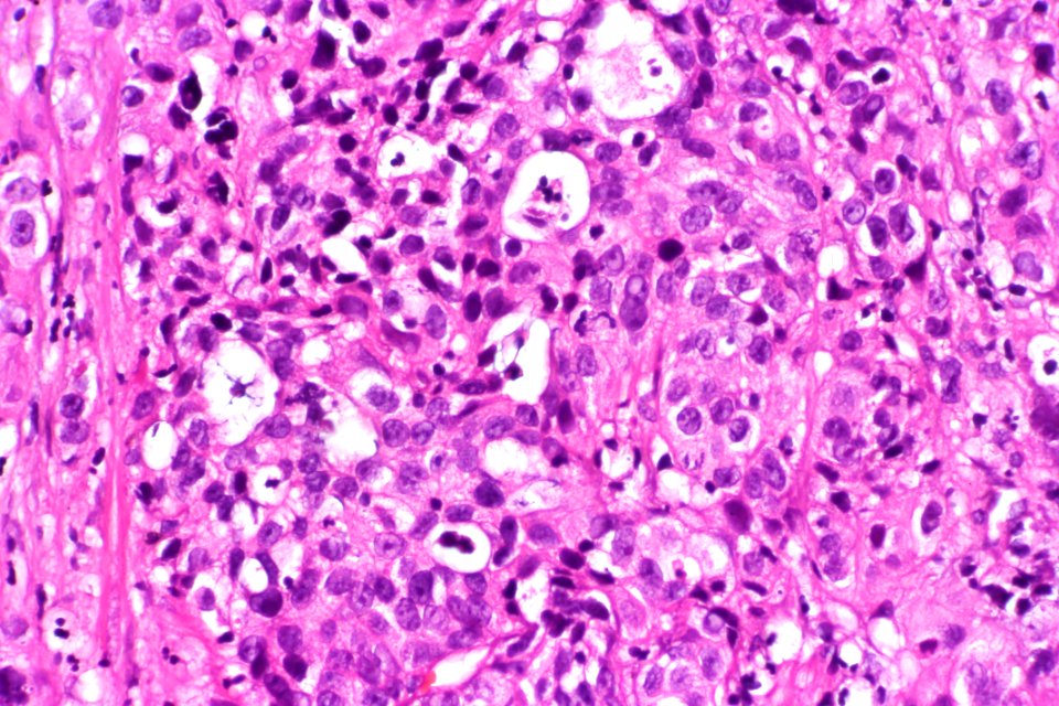 Urothelial carcinoma with glandular differentiation, very high mag.1