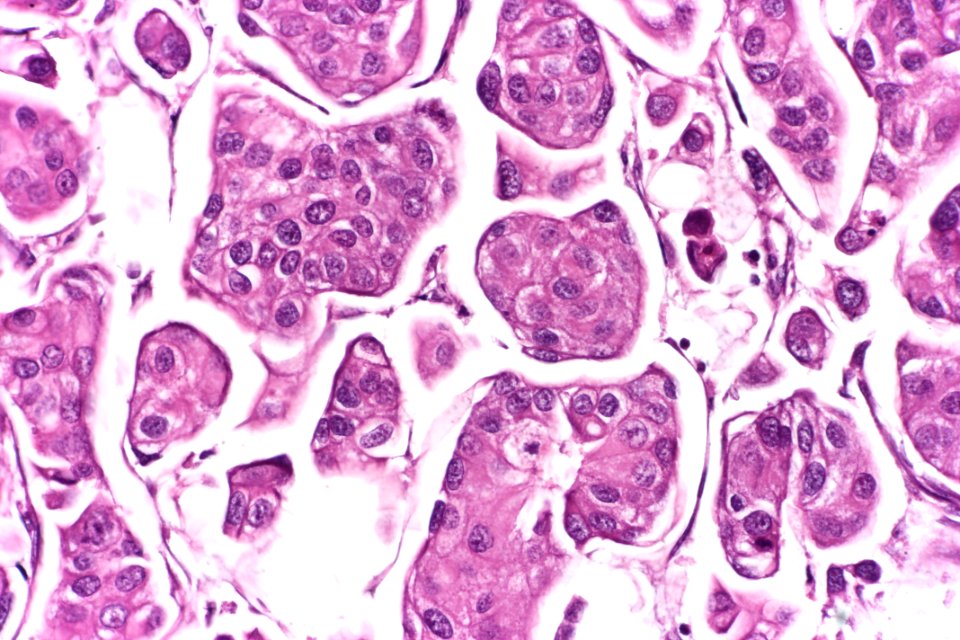 Urothelial carcinoma with micropapillary features, very high mag