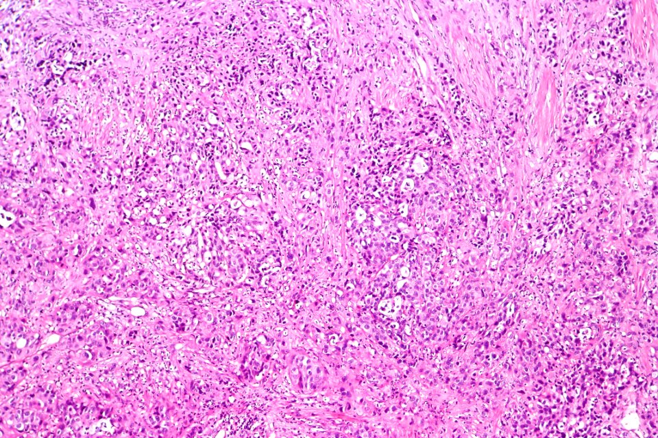 Urothelial carcinoma with glandular differentiation, intermed. mag.1