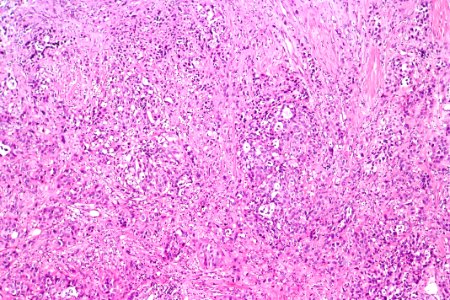Urothelial carcinoma with glandular differentiation, intermed. mag.1