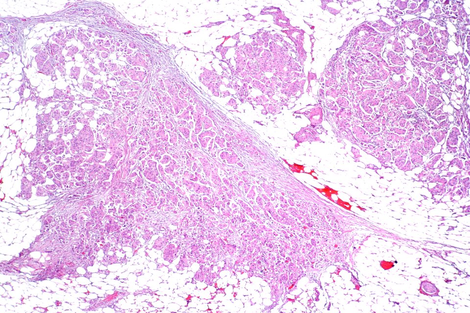 Urothelial carcinoma with micropapillary features, low mag.3