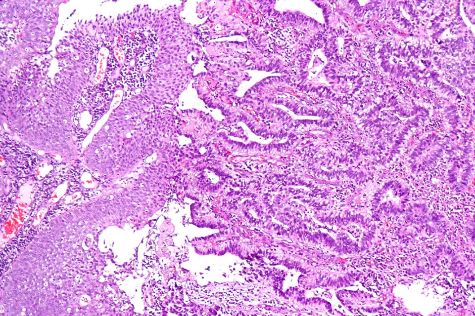 Urothelial carcinoma with villoglandular differentiation, intermed. mag.2