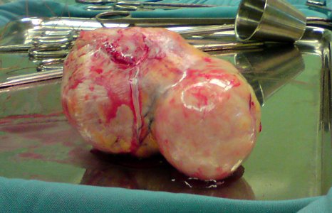 Uterine fibroid 02