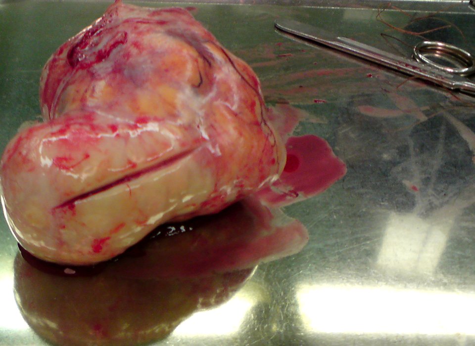 Uterine fibroid 04