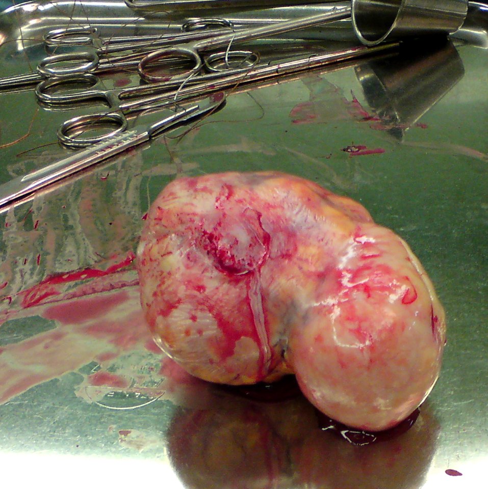 Uterine fibroid 03