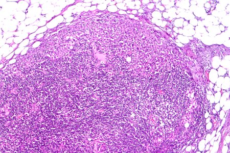 Urothelial carcinoma - lymph node metastasis, intermed. mag photo