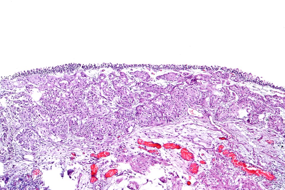 Urothelial carcinoma - nested variant, intermed. mag