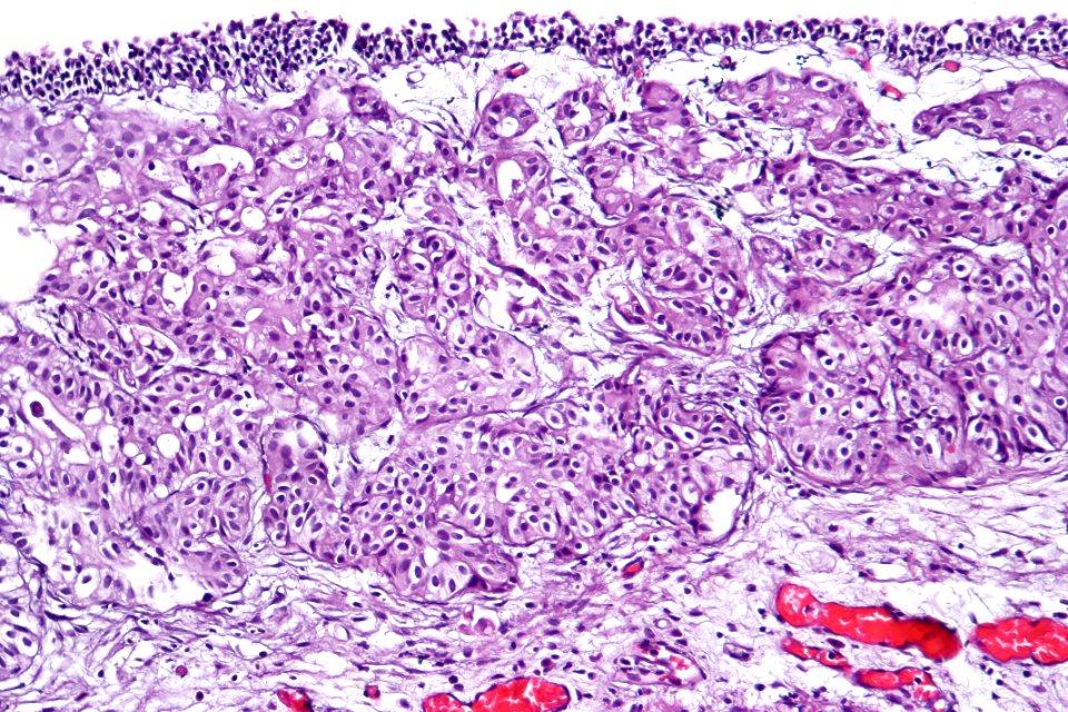 Urothelial carcinoma - nested variant, high mag