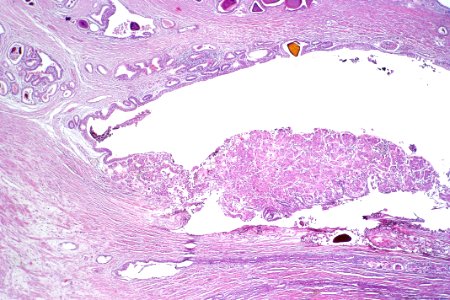 Urothelial carcinoma in the prostatic urethra, low mag