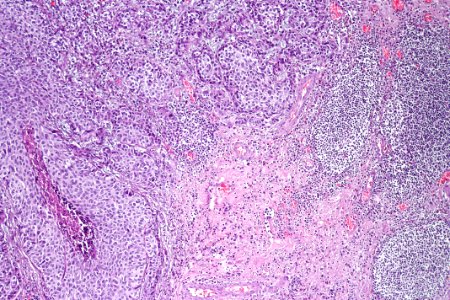 Urothelial carcinoma - stage pT1, intermed. mag
