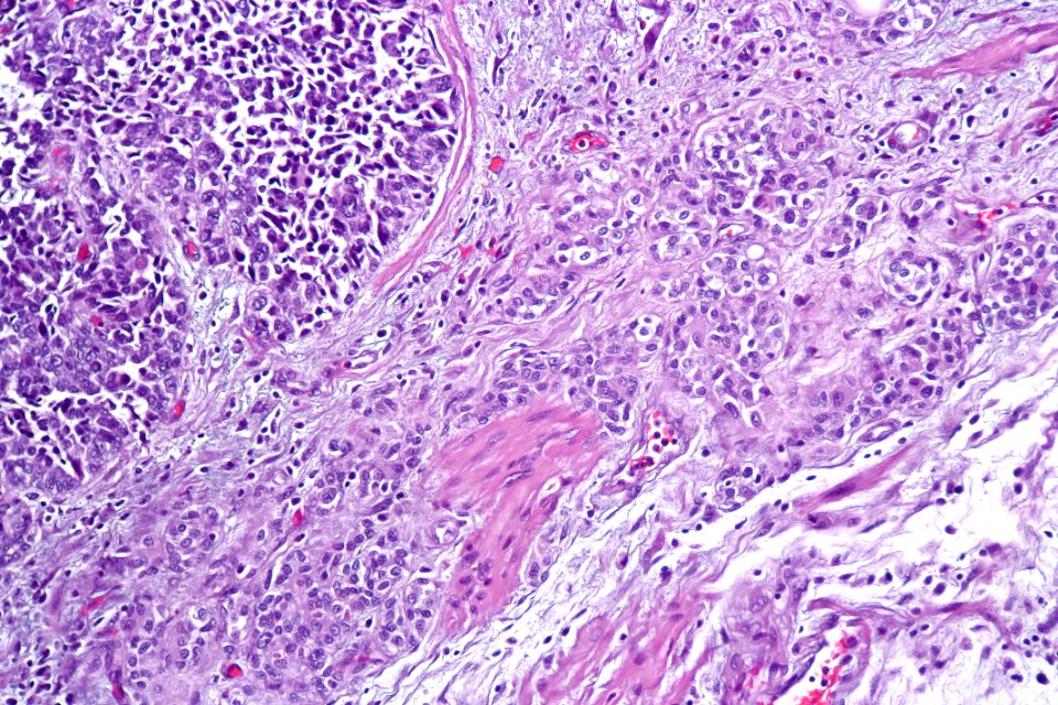 Urothelial carcinoma of the ureter, high mag