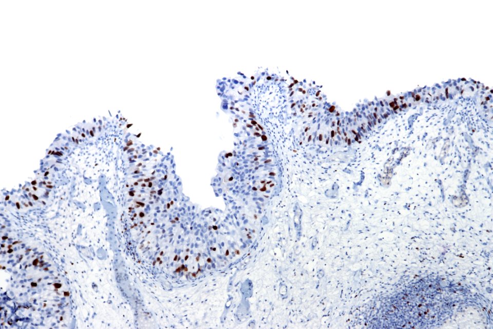 Urothelial carcinoma in situ - Ki67, intermed. mag