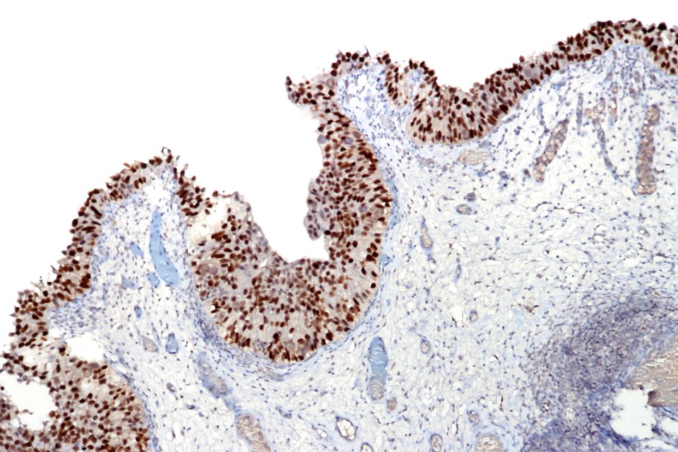 Urothelial carcinoma in situ - p53, intermed. mag