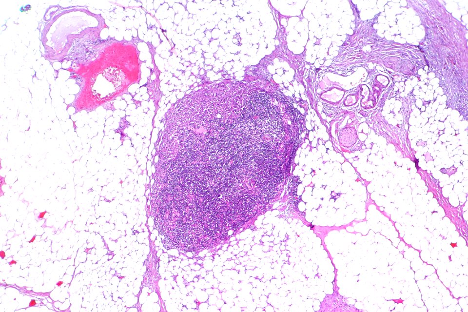 Urothelial carcinoma - lymph node metastasis, low mag