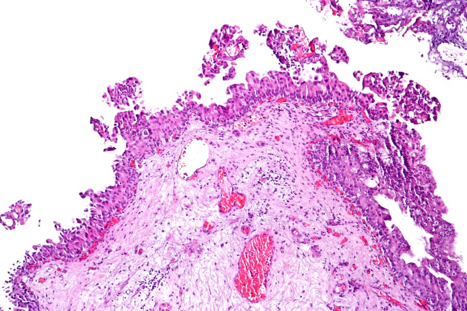 Urothelial carcinoma in situ (micropapillary), intermed. mag.1