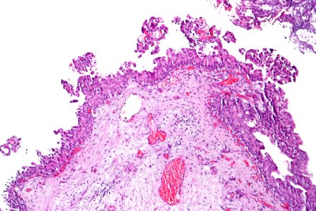 Urothelial carcinoma in situ (micropapillary), intermed. mag.1