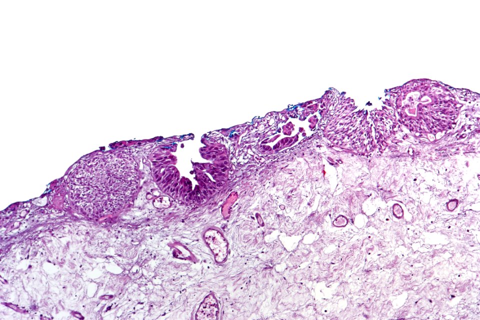 Urothelial carcinoma in situ (denuding), intermed. mag