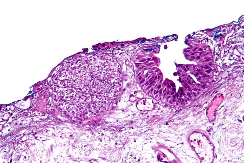Urothelial carcinoma in situ (denuding), high mag