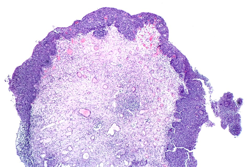 Urothelial carcinoma in situ (hyperplastic), low mag