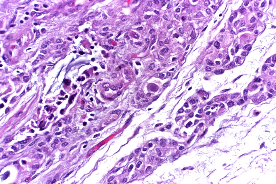 Urothelial carcinoma of the ureter, very high mag