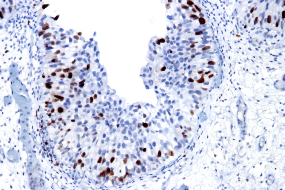 Urothelial carcinoma in situ - Ki67, high mag