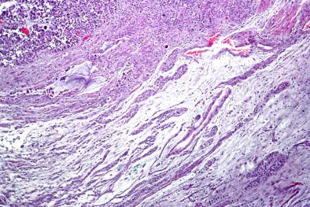 Urothelial carcinoma of the ureter, intermed. mag.1