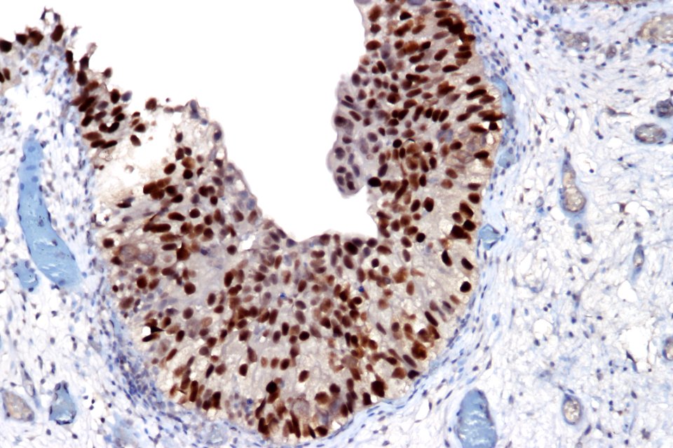 Urothelial carcinoma in situ - p53, high mag