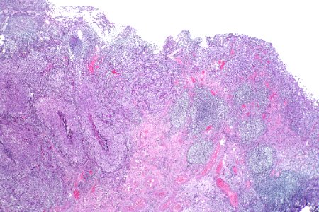 Urothelial carcinoma - stage pT1, low mag