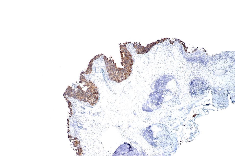 Urothelial carcinoma in situ - CK20, low mag