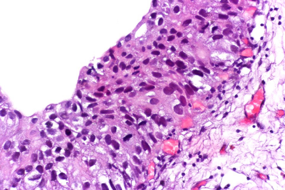 Urothelial carcinoma in situ, very high mag