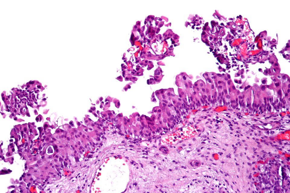 Urothelial carcinoma in situ (micropapillary), high mag