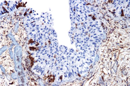 Urothelial carcinoma in situ - CD44, high mag