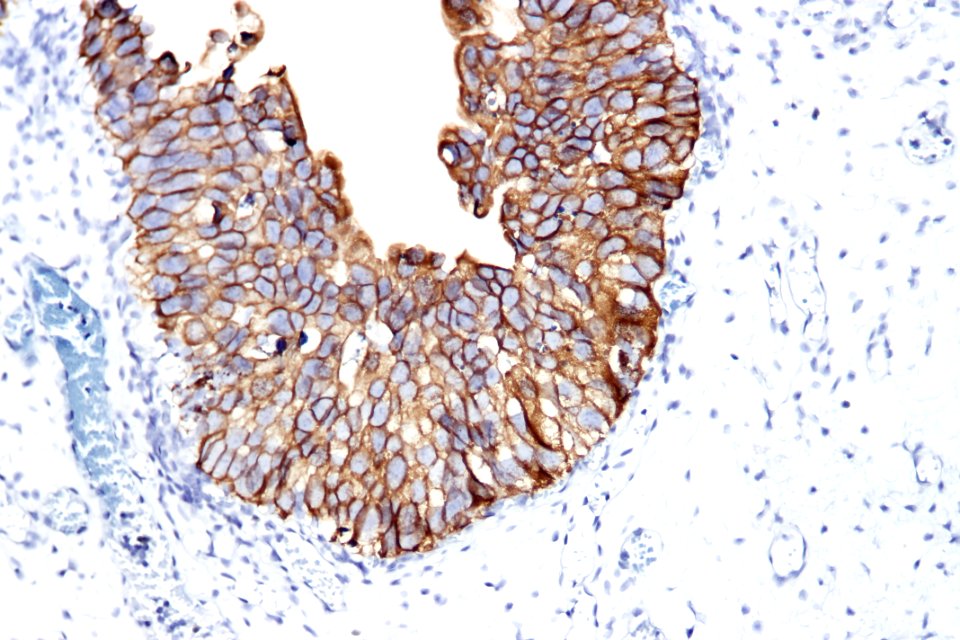 Urothelial carcinoma in situ - CK20, high mag