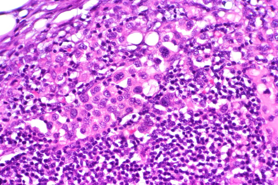 Urothelial carcinoma - lymph node metastasis, very high mag